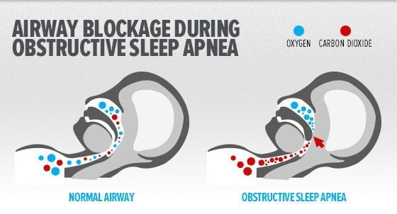 Sleep apnea, cpap devices, cpap masks, What is Sleep Apnea