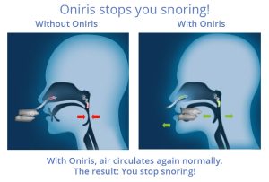 Oniris Plus Mandibular Advancement Anti Snoring Device,Oniris Plus